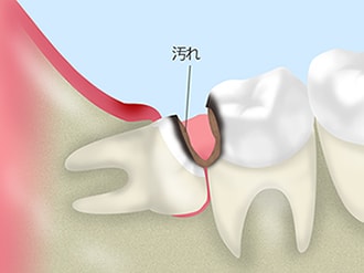 親知らずを抜いたほうがよい場合