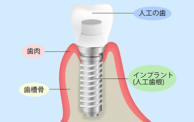 インプラントで自然な咬み心地を取り戻しましょう