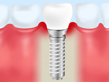 メインテナンスでインプラントの寿命を延ばしましょう