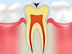 C1【エナメル質の虫歯】 