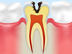 C2【象牙質に達した虫歯】 