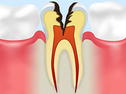 C3【神経に達した虫歯