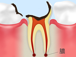 C4【歯根に達した虫歯】 