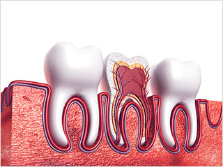 根管治療とは