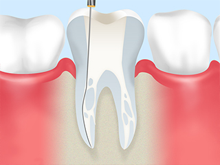 根管治療とは