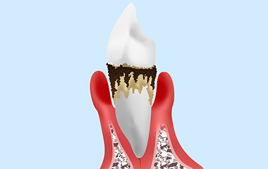 重度歯周炎