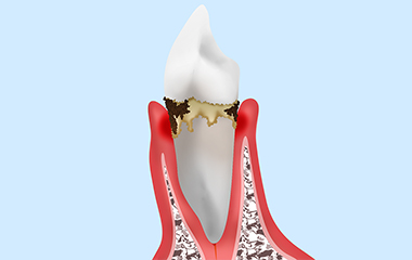 軽度歯周炎