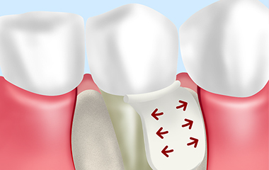 歯周再生治療