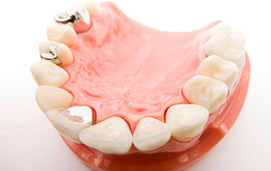 審美歯科で目立つ銀歯を白くしたい